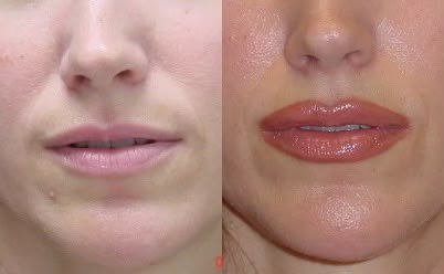 Precision Dermal Injections