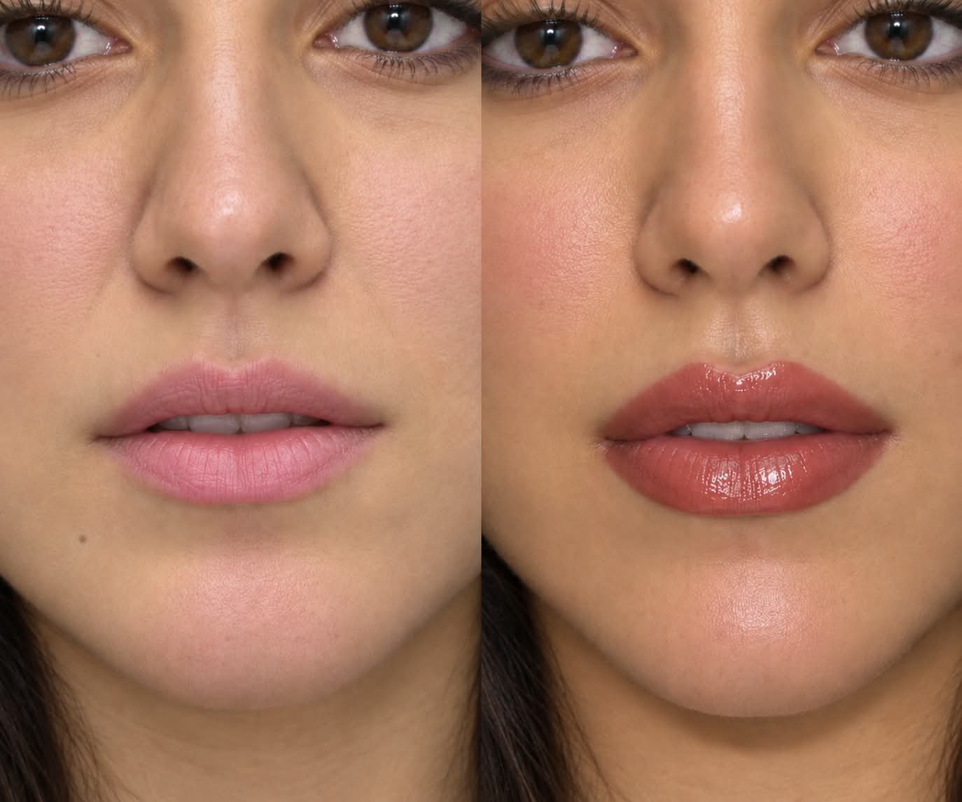 Dermal filler treatments at Maison Lumiere Aesthetics